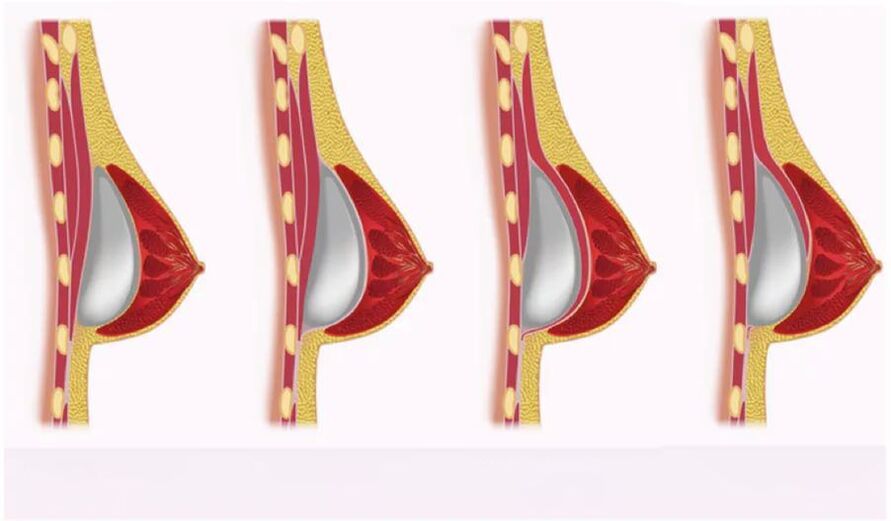 Accès pour l'installation de l'implant